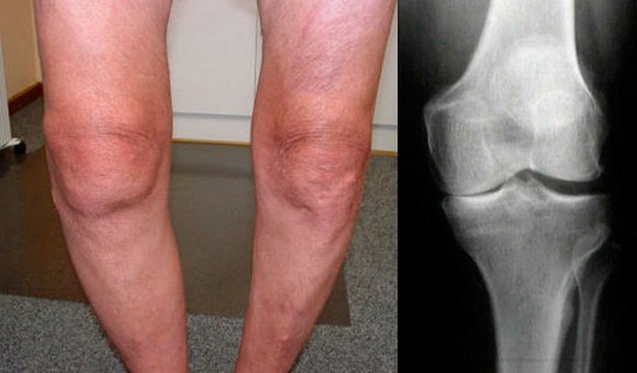 Есть ли разница между артрозом коленного сустава и гонартрозом ?