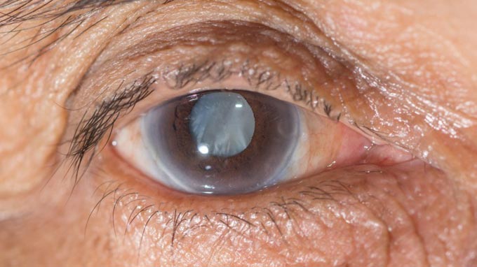 глаукома в старости