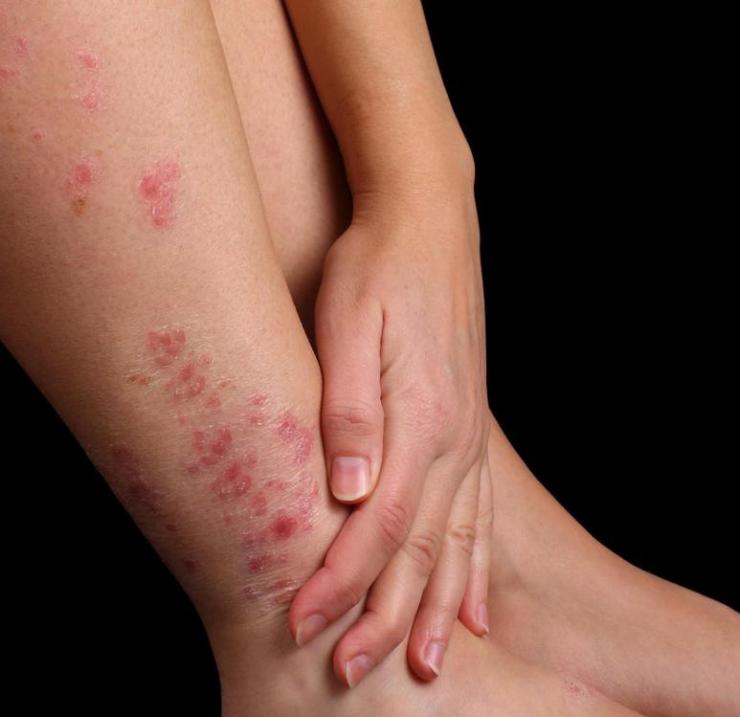 Лечение различных видов дерматита на ногах