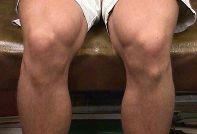 Уплотнения на ноге в районе колена