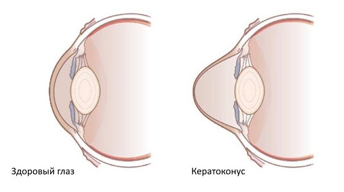 что такое кератоконус глаза