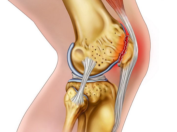 Безоперационное лечение разрывов мениска коленного сустава