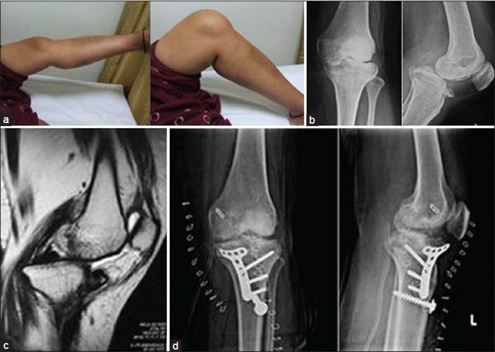 Сроки лечения перелома мыщелка коленного сустава