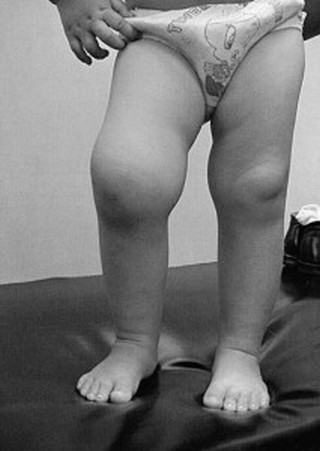 Артрит коленного сустава у детей