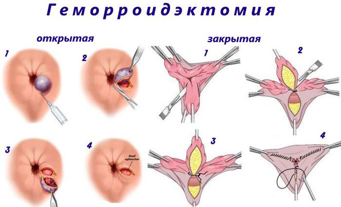 Геморроидэктомия