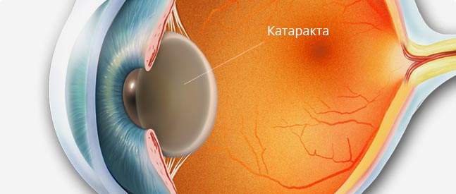 травматическая катаракта глаза