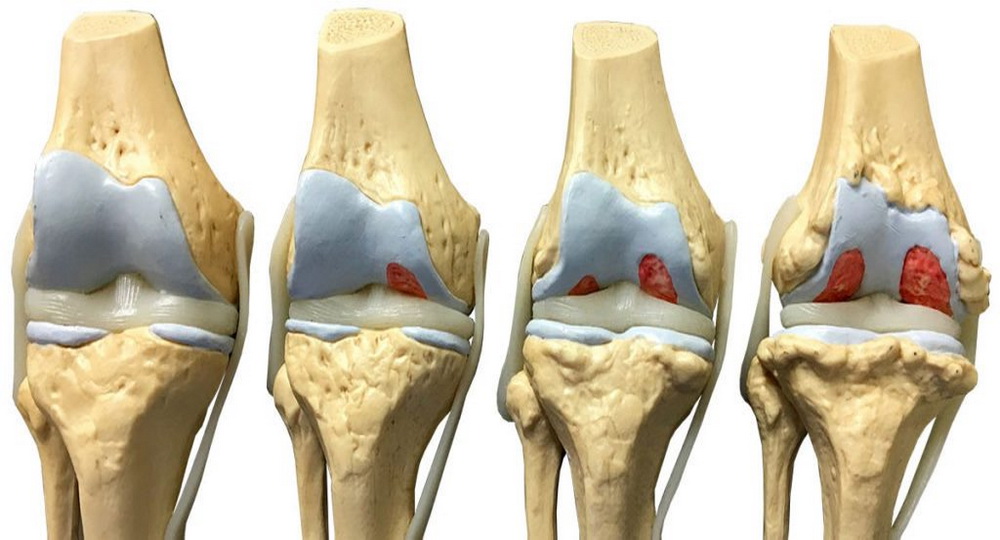 Способы лечения деформирующего артроза колена 3 стадии