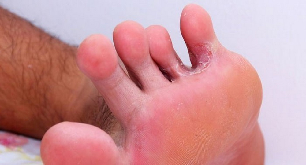 Почему лопается кожа между пальцами ног: причины и лечение в домашних условиях