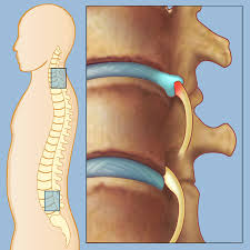herniated-cervical-spine