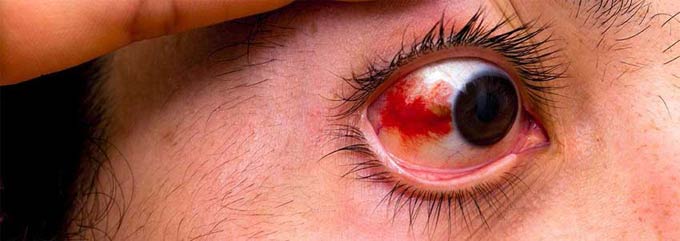 лечение повреждений роговицы глаза