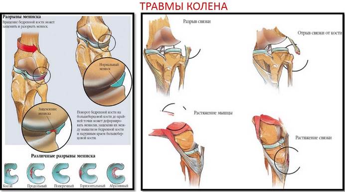 Травмы колена