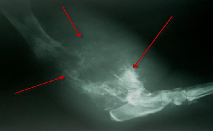 Остеогенная саркома крыла подвздошной кости