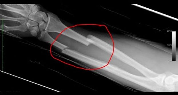 Рентген перелома руки