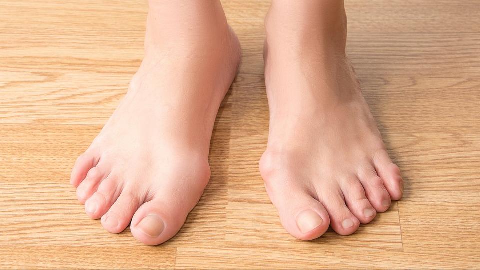 Эффективные способы лечения вальгусной деформации стопы у взрослых
