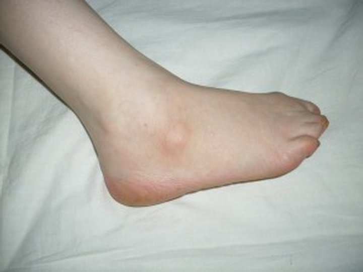 Причины шишек на ноге под кожей