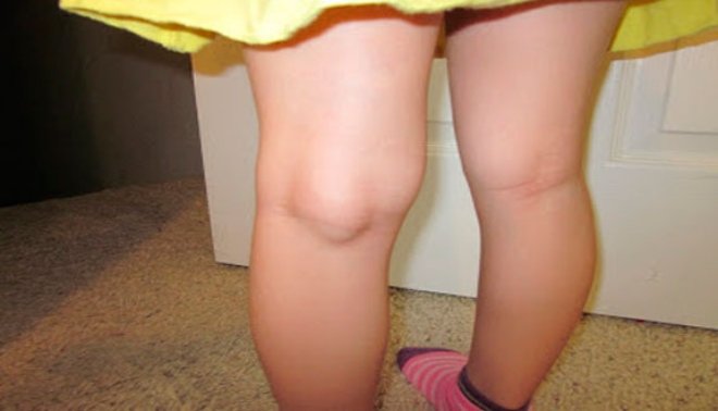 Специфика и виды операций по удалению кисты Бейкера коленного сустава