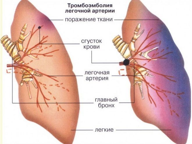 Тромбоз и эмболия артерий нижних конечностей