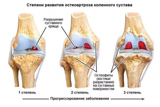 Как применять желатин при артрозе суставов ног