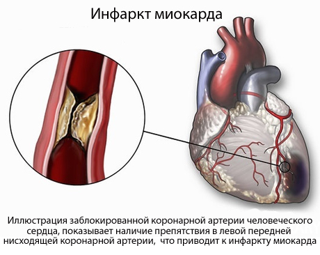 Инфаркт сердечной мышцы
