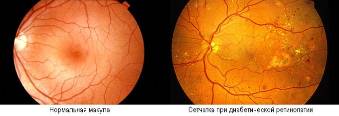 сетчатка при диабетической ретинопатии