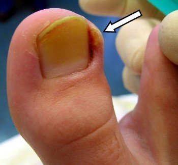 Симптомы и лечение панариция большого пальца ноги