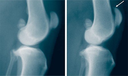 Причины и лечение остеохондромы коленного сустава