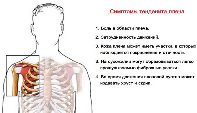 Симптомы тенденита плеча