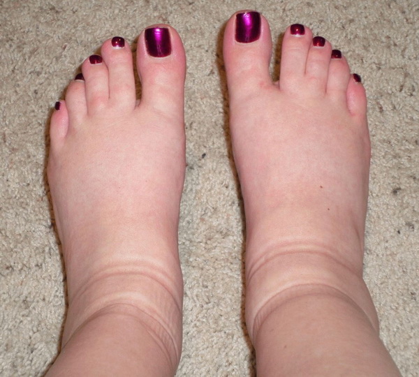 Почему опухают ноги в районе стопы у женщин, лечение отеков