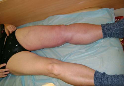 Классификация и лечение флеботромбоза глубоких вен ног