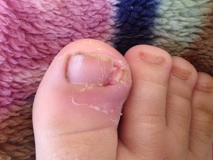Лечение состояний, при которых палец ноги болит около ногтя