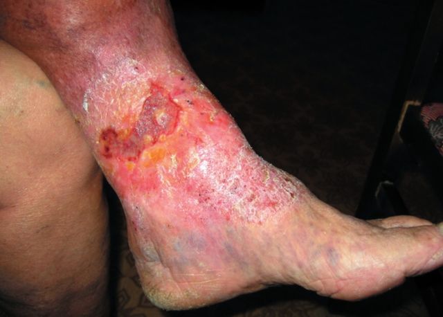 Терапия варикозной экземы на ногах