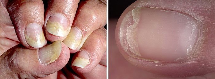 Виды дистрофии ногтей больших пальцев ног