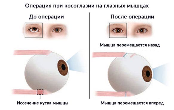 операция на глазных мышцах