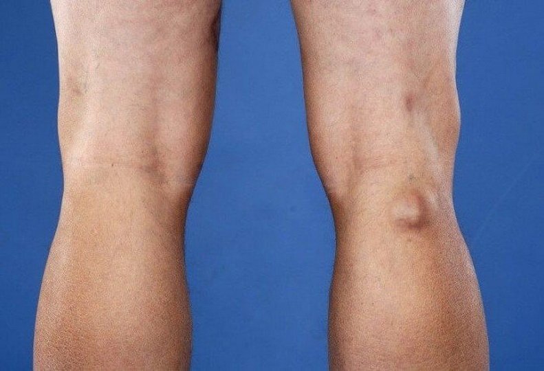 Локализация и причины воспаления лимфоузлов на ногах