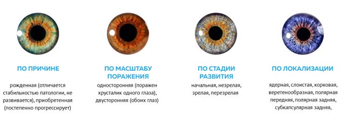 разновидности катаракты