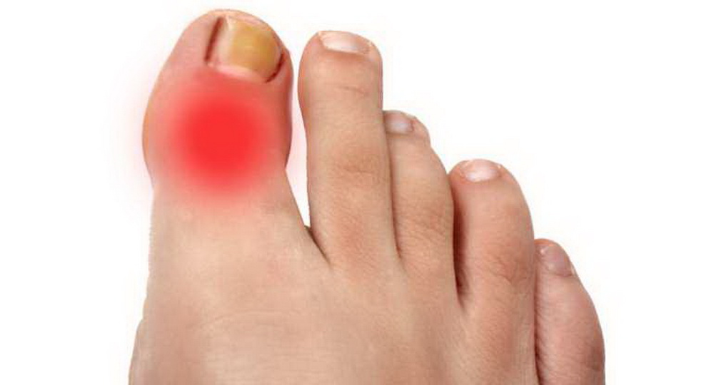 Симптомы и лечение артроза пальцев ног
