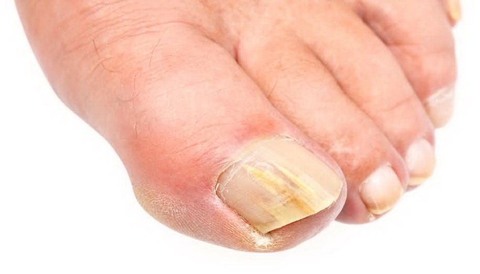 Причины появления дрожжевого грибка ногтей