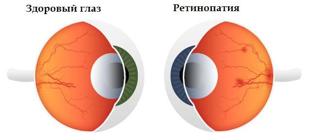 ретинопатия сетчатки глаза