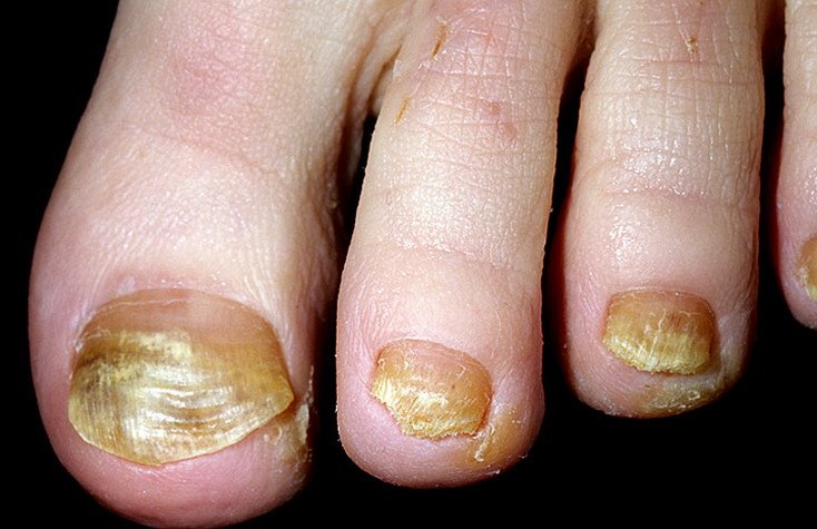 Виды дистрофии ногтей больших пальцев ног