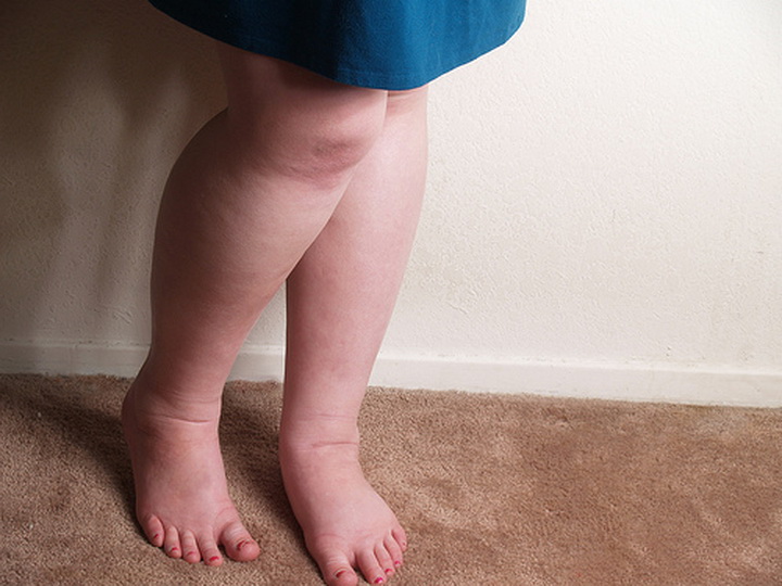 Что делать, если отекают ноги при беременности?