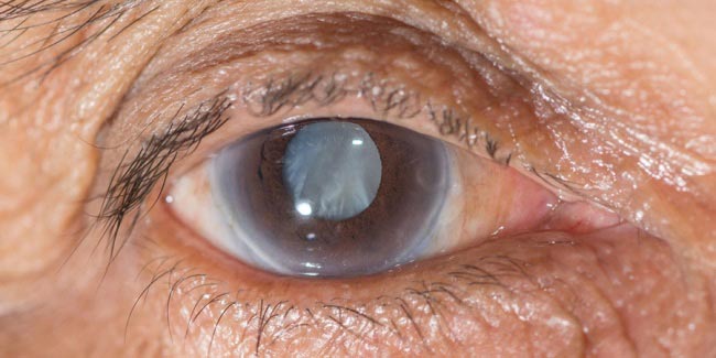 симптомы остроугольной глаукомы
