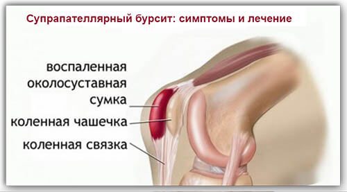 Лечение и профилактика супрапателлярного бурсита коленного сустава