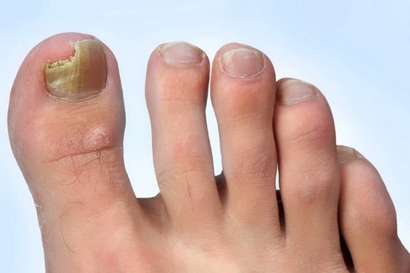 Применение нашатырного спирта при лечении грибка ногтей