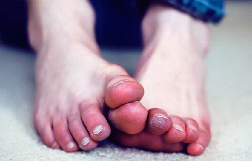 Причины и лечение онемения пальцев ног
