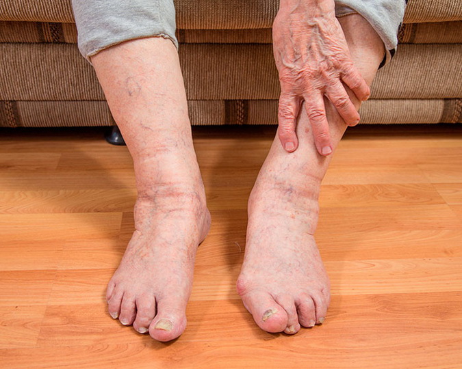Почему отекают ноги у пожилых людей и как лечить отеки