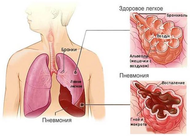 Пневмония 