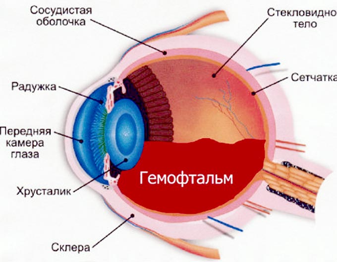 частичный гемофтальм глаза