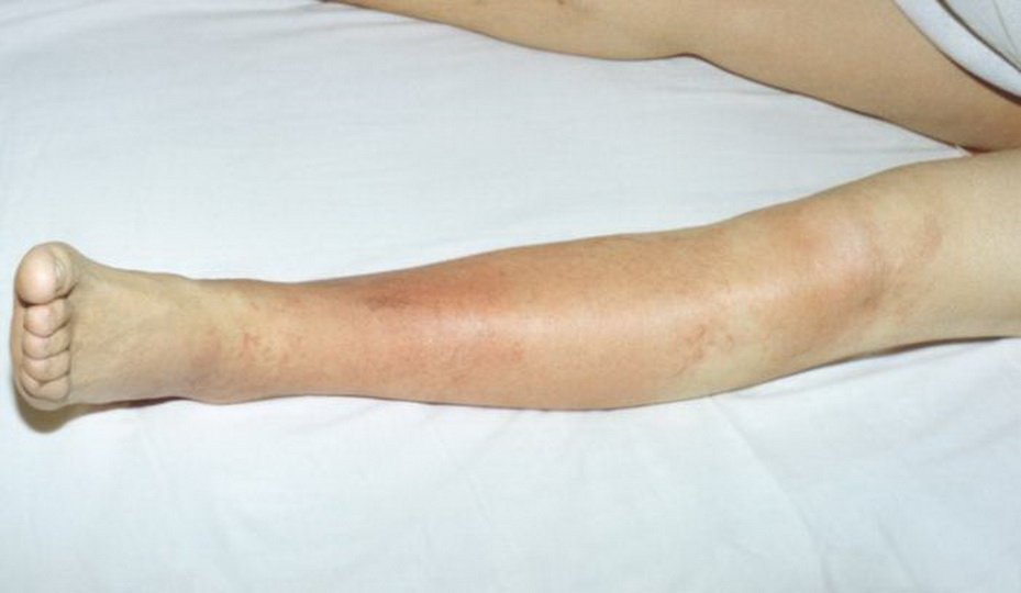 Эритематозная рожа ног: код по МКБ-10, симптомы, лечение