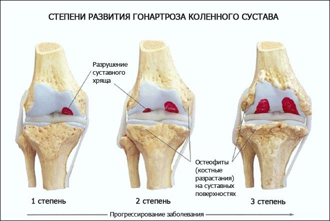 Гонартроз коленного сустава