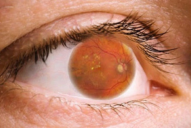 Особенности диабетической ретинопатии